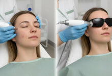 comparison of microneedling vs. fractional laser treatments for old acne scars, set in a professional dermatology clinic. On the left, an aesthetician performs microneedling on a patient's facial scars. On the right, a patient wearing protective goggles receives a fractional laser treatment, showing the different techniques for skin resurfacing. The patient wears a sage green gown