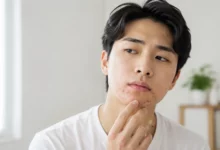 Young man with acne around chin and mouth area touching his face in a bright minimalist room