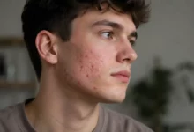Close-up of a young man with cheek acne and visible skin texture for acne causes and skincare solutions blog post